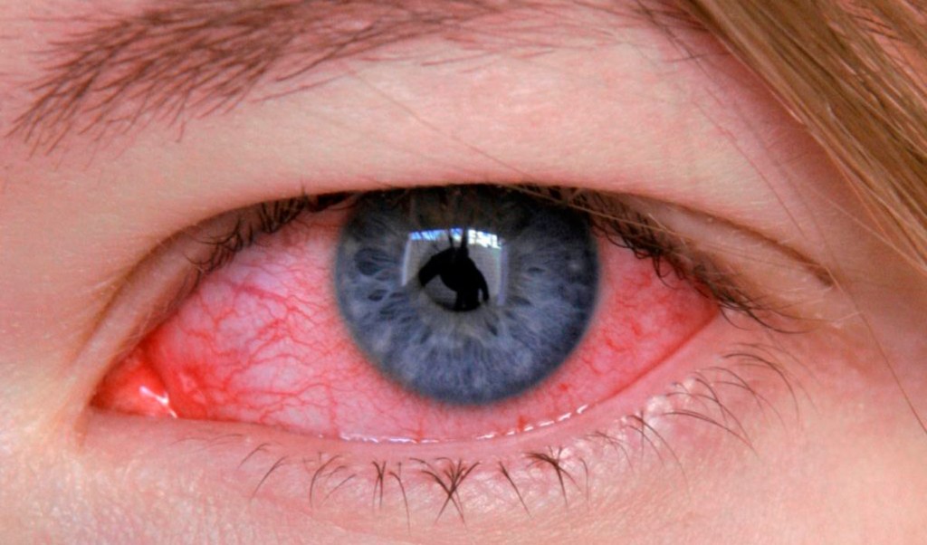Конъюнктивит: почему краснеют глаза и как их лечить