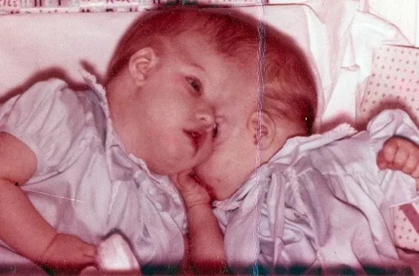 Старейшие сиамские близнецы Лори и Джордж Шаппелл скончались в США