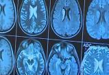 Новый способ предсказать приступ эпилепсии разработали учёные США