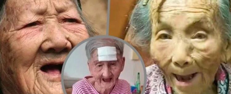 «Рог» на лбу: 98-летняя китаянка сама срезала нарост и чуть не умерла