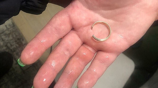 Чтобы снять кольцо, женщине пришлось вызвать МЧС